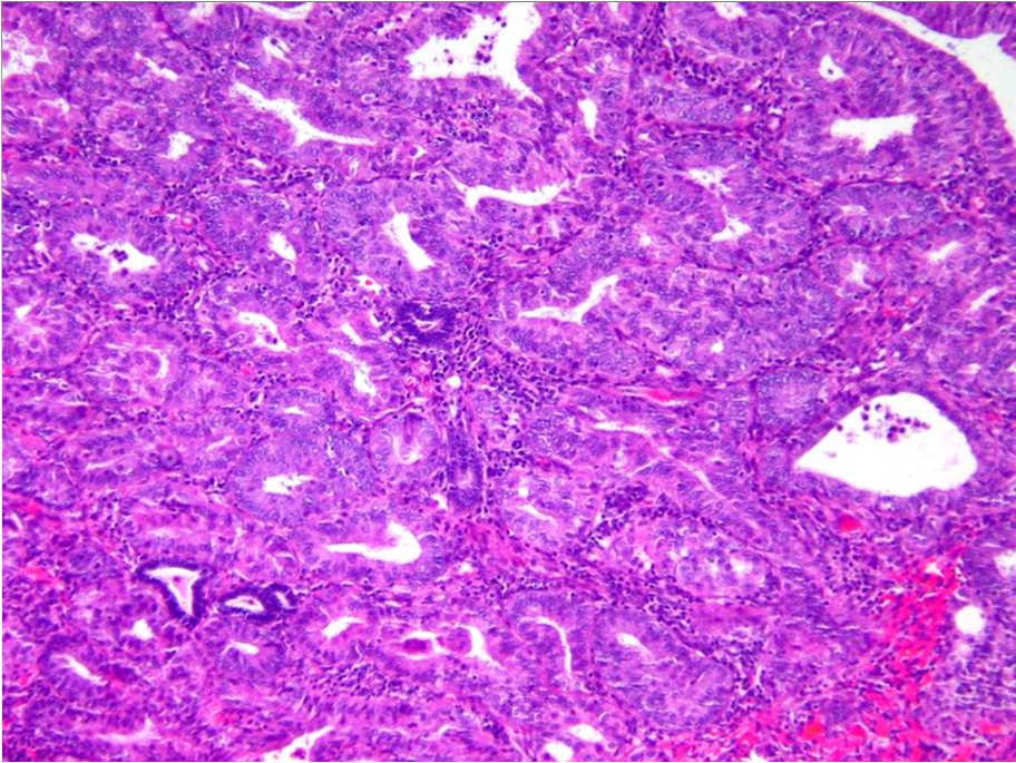 Endometrial intraepithelial neoplasia (EIN) (Mutter & Baak, 2000) Clonality determinations of carcinomas: selected MSI endometrial carcinomas or women who are heterozygotes at HUMARA (human androgen