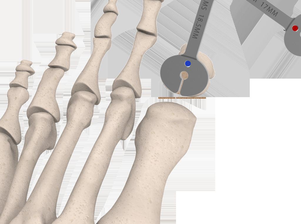 Important Note Release the sesamoid complex with an elevator instrument.