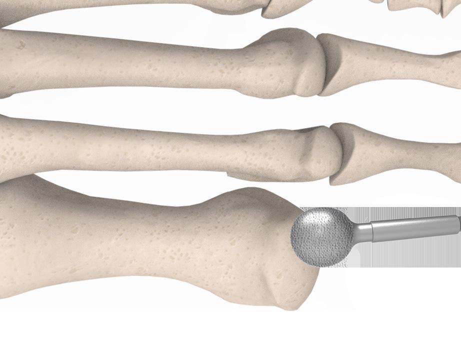 Bend slightly to create a greenstick fracture. Remove this dorsal bone component leaving the plantar edge intact.