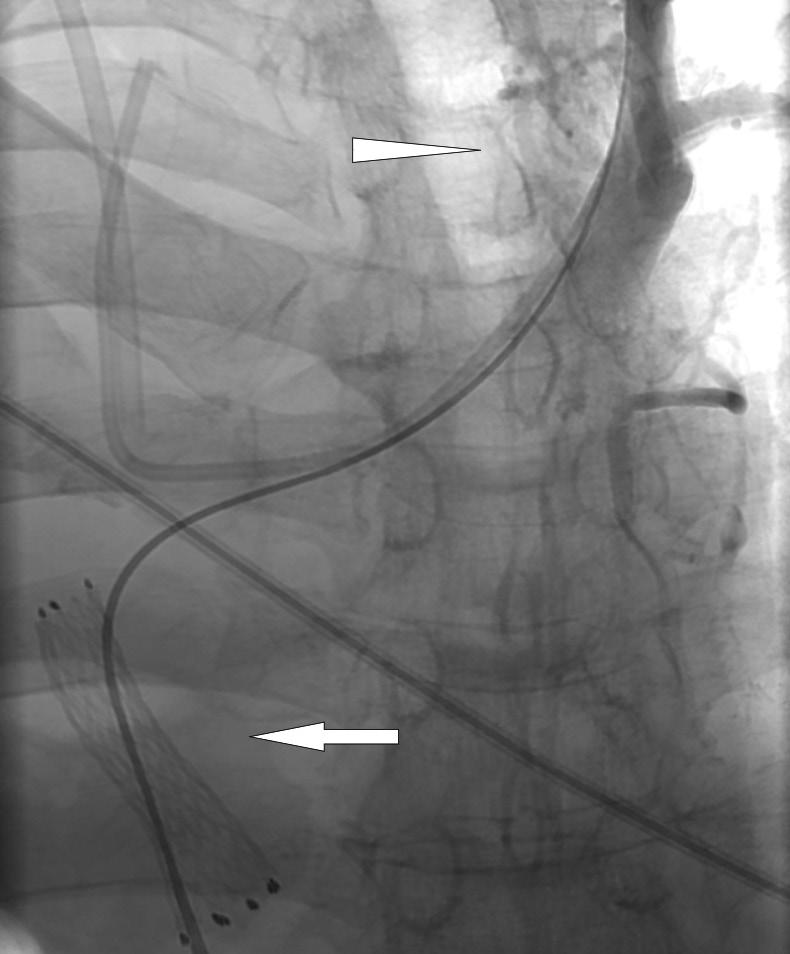After repositioning tip of port-catheter into right brachiocephalic vein