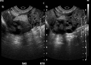 Bilateral adnexal masses appearing either as small solid masses or as cystic masses with thick