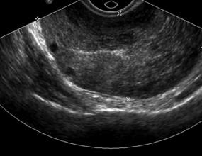 PRF setting) Ovarian color Doppler signal has been frequently reported in cases of surgically proven torsion!