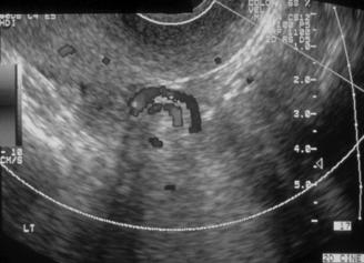 Sonography is initial exam of choice Computed tomography is being used more frequently Appendicitis