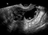 cavity and /or cul-de-sac ovarian enlargement often