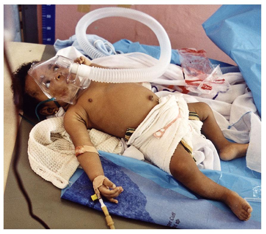 P. falciparum Child with severe malaria anemia in