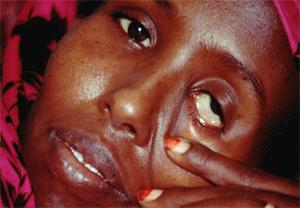 with malaria ( blackwater fever ) is uncommon and malarial
