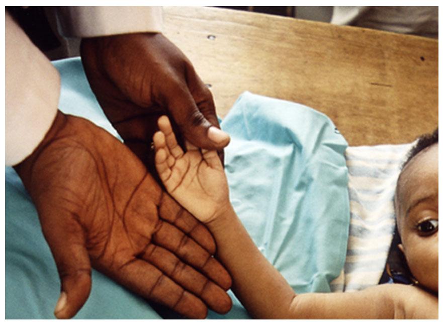 Complications of malaria : anaemia Child with