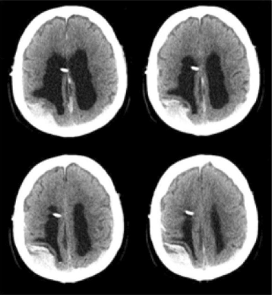 Hayes et al. Journal of Medical Case Reports 2012, 6:393 Page 2 of 5 Introduction Normal-pressure hydrocephalus (NPH) usually presents in older patients.