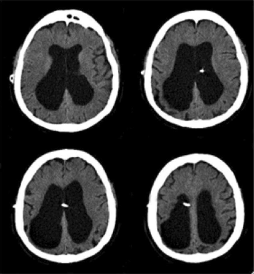 Hayes et al. Journal of Medical Case Reports 2012, 6:393 Page 4 of 5 Figure 3 Computed tomography scan one year after subdural hematoma.