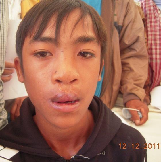 Bilateral Cleft