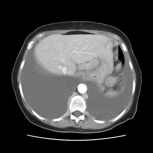 Our Patient s Body CT Scan (With Contrast) Before Treatment