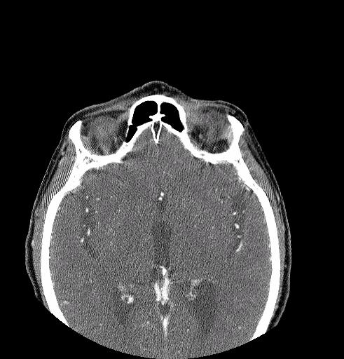 Our Patient s CT Scan of Orbits After Treatment (with contrast) No tumor is visible in the superior aspect of