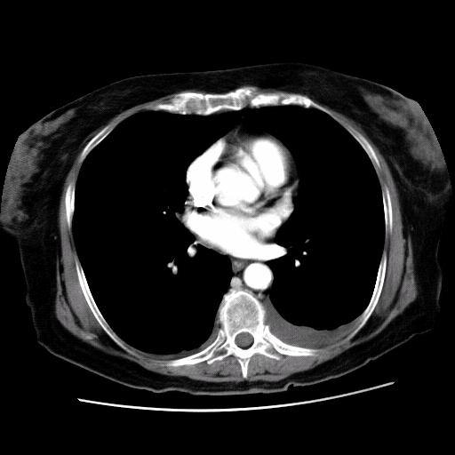 Our Patient s Body CT Scan After Treatment There has been an extensive reduction in chest pathology.
