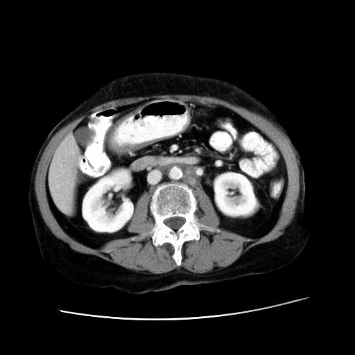 Our Patient s Body CT Scan After Treatment Some para-aortic lymphadenopathy remains.