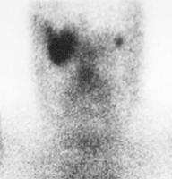 Planar Image of the Head & Neck (Gallium-67 Scintigraphy Scan) Obtained from another patient who also had right sided orbital lymphoma Shows increased uptake of Gallium-67 limited to the right