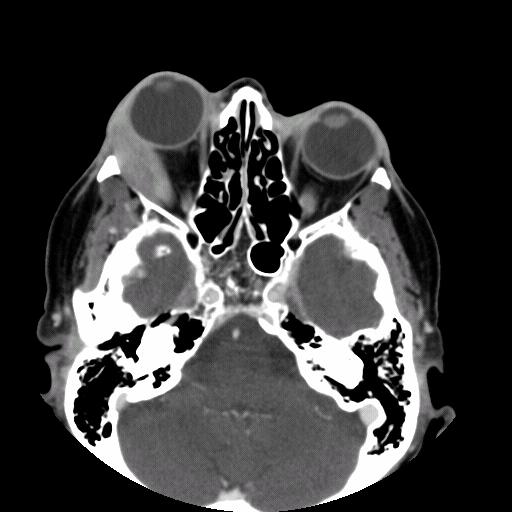 Our Patient s CT Scan of Orbits (with contrast) Marked displacement of the globe anteriorly.