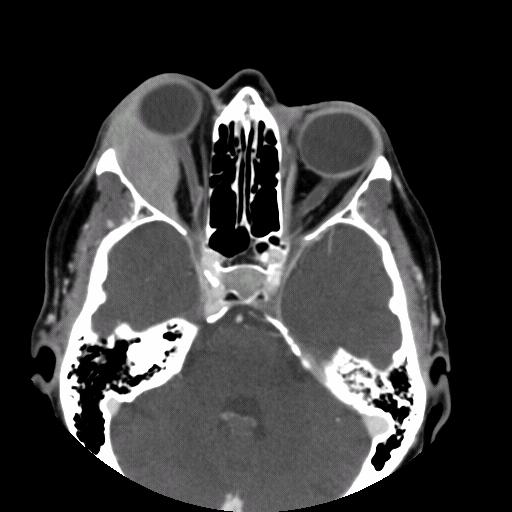 Our Patient s CT Scan of Orbits (with contrast) The right lateral rectus muscle is not seen. The mass is either displacing, encasing or expanding it.