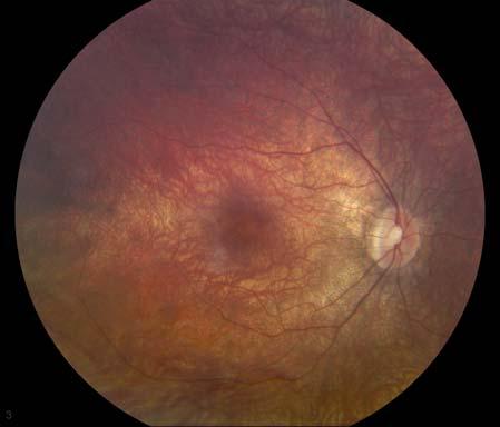 Figures 1 and 2: Fundus photos with punctuate yellow dots and pigment mottling of the retina pigment