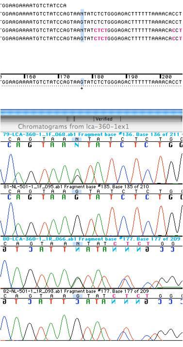 Figures 5 and 6: ABI bidirectional sequencing chromatograms depicting the two genetic variations in the RPE65 gene which are responsible for this patient s LCA: Panel A = IVS1+5 G>A, Panel B =