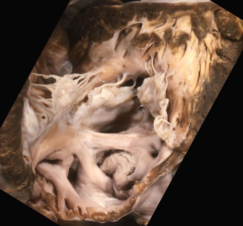 SBL IBL Right ventricle