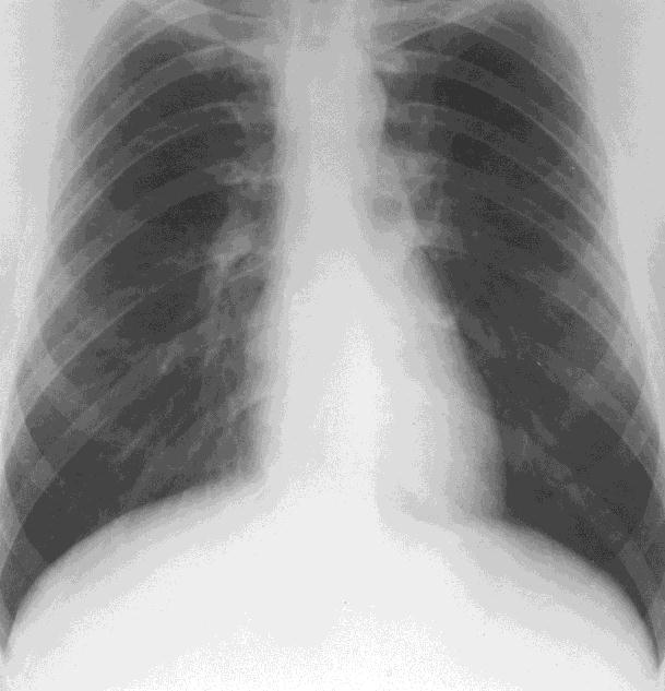 CHEST X RAYS POSTEROANTERIOR (PA) LATERAL This patient s chest X rays