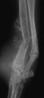 2 of 9 9/29/2014 8:25 PM The most commonly implicated cause of primary bone tumors is previous bone damage.