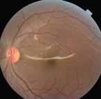 Posterior pole retinal photo showing good aspect of macula at postoperative day 1 (A).
