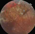 Posterior pole retinal photo showing good aspect of macula at 1 week (D).