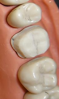 Objective Assessment of: Occlusal Reduction Depth Consistent for chosen