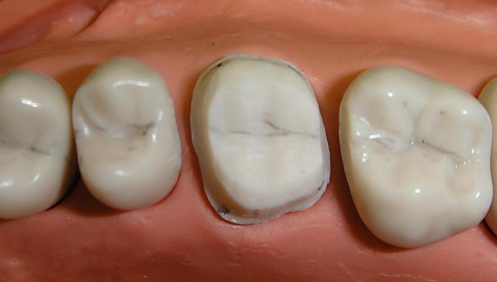 Objective Assessment: Occlusal reduction Keep the position of the: Central Fossae Cusp and cusp tips similar