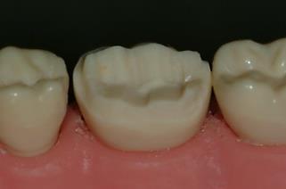 Preparation Specifications Externally similar to FGC preparation except that the restoration margins are positioned occlusally Occlusal Reduction: 1.0mm Non-Functional 1.