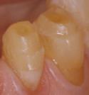 Minimal Occlusal Coverage Preparations: Suggestions Only take out