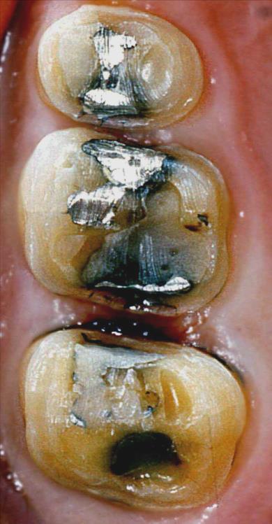 Minimal adhesive posterior tooth preparations: (Chana et al 2000) No retention /