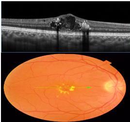 Figure 2: Macular Edema Identification in OCT and Fundus Image The paper proposes a novel method for identification of Macular Edema in Retinal OCT images using Iterative prototyping SDLC model.