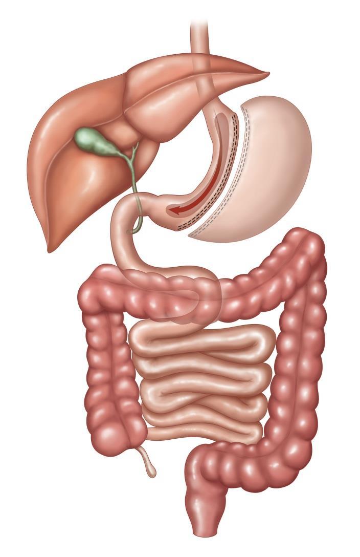 Vertical Sleeve Gastrectomy Mostly a restrictive procedure Some altered hunger