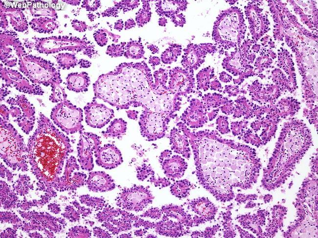 Papillary renal cell carcinoma, morphology Grossly: hemorrhage, necrosis and cystic