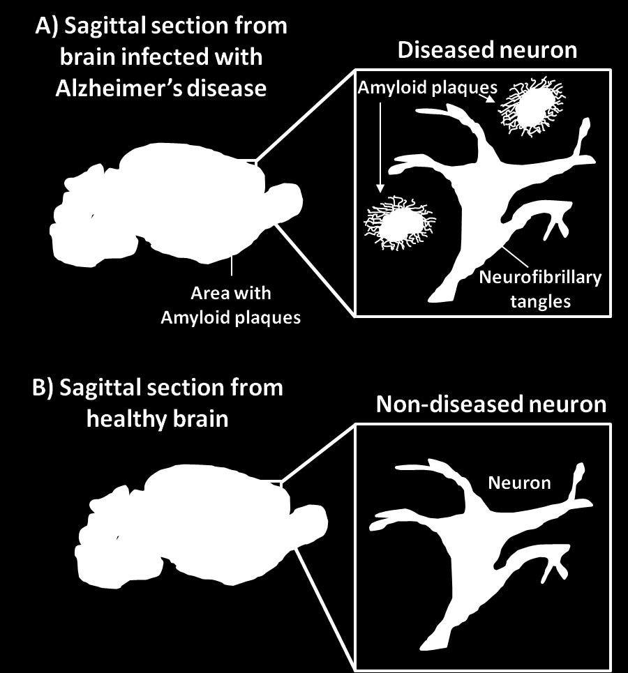 Illustration (A) displays the effects of the disease on the generation of neurofibrillary tangles inside the neuron and the extracellular deposition of Aβ protein in plaques around the cortical and
