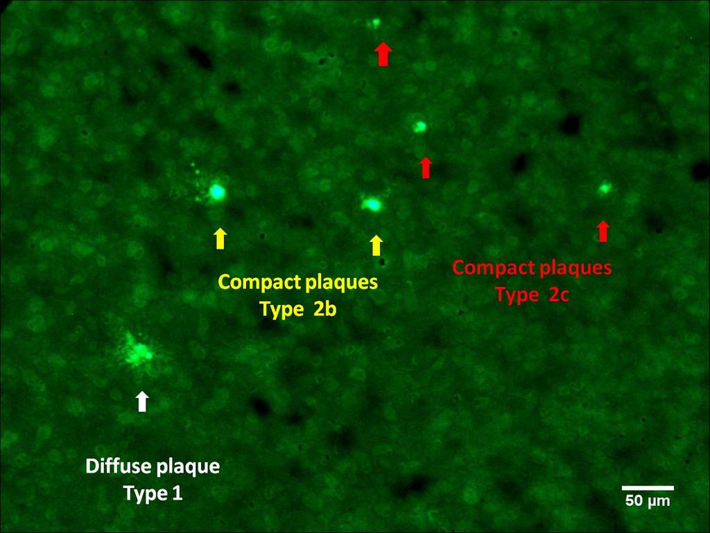 Type 2b: plaques with a dense central core and only a few fibrils around it Type 2c: burned-out plaques or very compact plaques are the brightest under fluorescence microscopy and do not have any