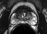 d 7, 8, 9 and 10 Poorly differentiate d mid apex sagittal Modified from F. D.