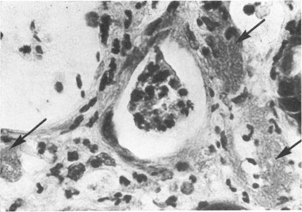 The lamina propria also showed some oedema (Fig. 1). In the mucosa adjacent to the pseudomembranous lesions, the inflammatory infiltrate in the lamina propria was less marked.