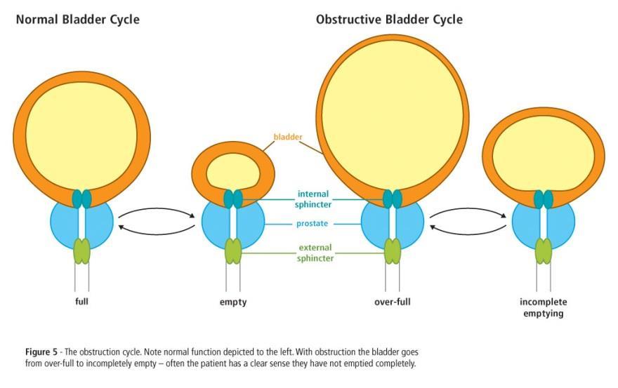 prostate enlargement or other obstruction Neurogenic (flaccid) bladder