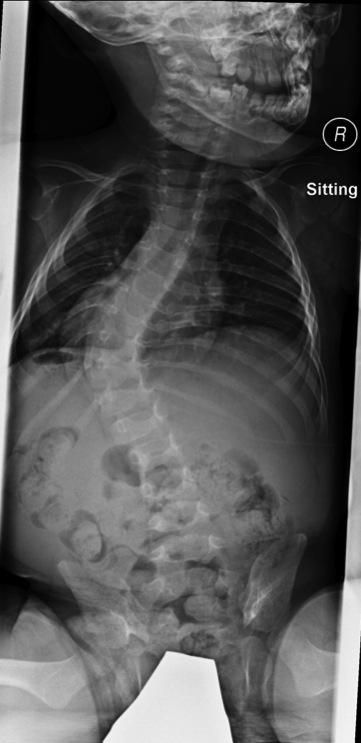 Infantile Idiopathic Scoliosis Onset 0-3 yrs Ratio: M = F (1:1) Curve Pattern: Left Thoracic Associated findings: packaging