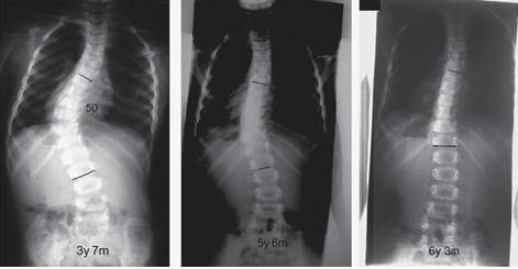 scoliosis no surgery Not all
