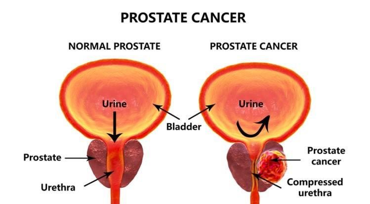 Carcinoma of Prostate Most common cancer in United States with exception of skin cancer Increases in new cases by 50% between 1980 and 1990 New cases in 2009 192,280 (Est.