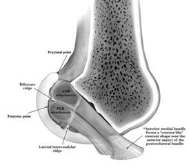 marrow edema Cruciate Ligaments Anterior Cruciate Ligament Origin: Lateral femoral condyle (medial) Insertion: Medial tibial eminence (anterior) Function: