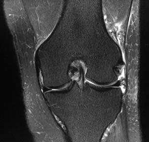 ACL PCL Medial Lateral ACL tear: Pivot Shift