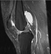 org, rid: 3580 Cruciate Ligaments Posterior