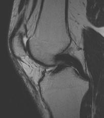 displacement of tibia when knee flexed Thicker