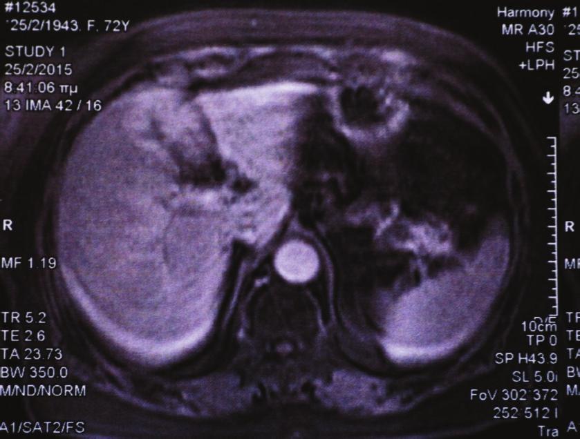 2 Case Reports in Surgery (a) (b) Figure 1: A mass in the tail of the pancreas with (a) strong enhancement and with (b) rapid washout, MRI images. (a) (b) (c) Figure 2: Histological examination.