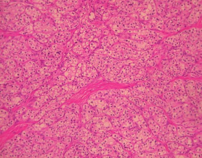 The patient had no other events, and she was discharged from the hospital on the fifth postoperative day. Histological examination demonstrated a solid serous adenoma of the pancreas.